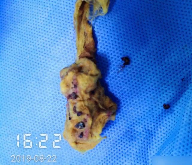 阑尾炎形成窦道的原因,阑尾炎一孔微创手术全过程