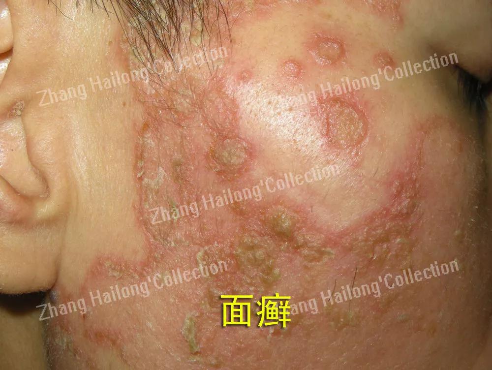 小狗脸上长癣怎么办,孩子脸上长癣是怎么回事啊