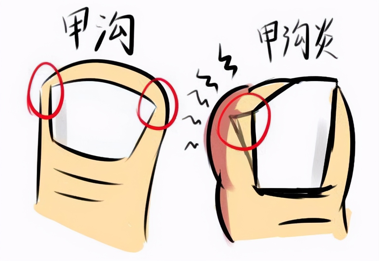 甲沟炎有什么需要注意的事项,甲沟炎恢复过程中会遇到的问题