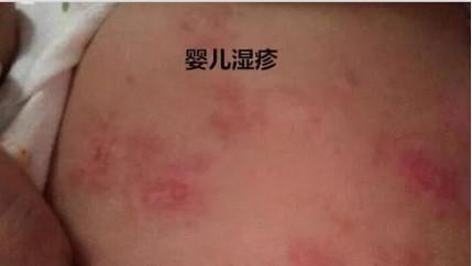 宝宝爱起疹子擦什么保湿霜,宝宝爱起热疹用什么沐浴露好