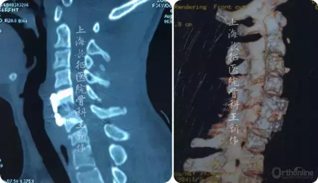 颈椎外伤受损如何治疗,颈椎损伤手术恢复怎么样