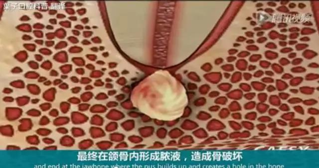 牙龈反复鼓包流脓是牙齿坏了吗,一上火牙龈就鼓包