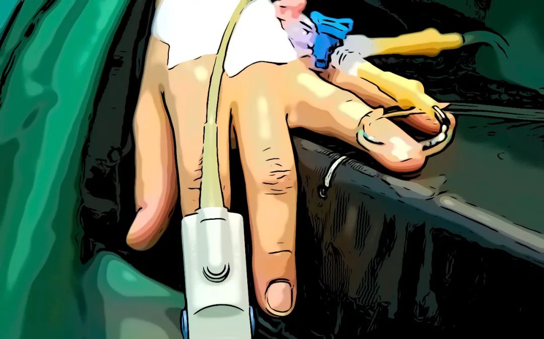 全麻清醒后有什么感觉,全麻手术清醒的感觉