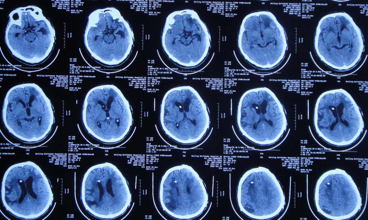 颅脑外伤术后脑积水,脑外伤脑积水颅骨缺失