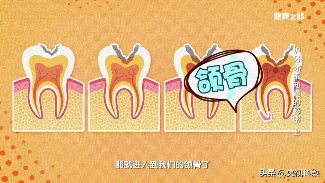 刷牙出血吃东西塞牙是怎么回事,刷牙时牙缝出血是什么原因