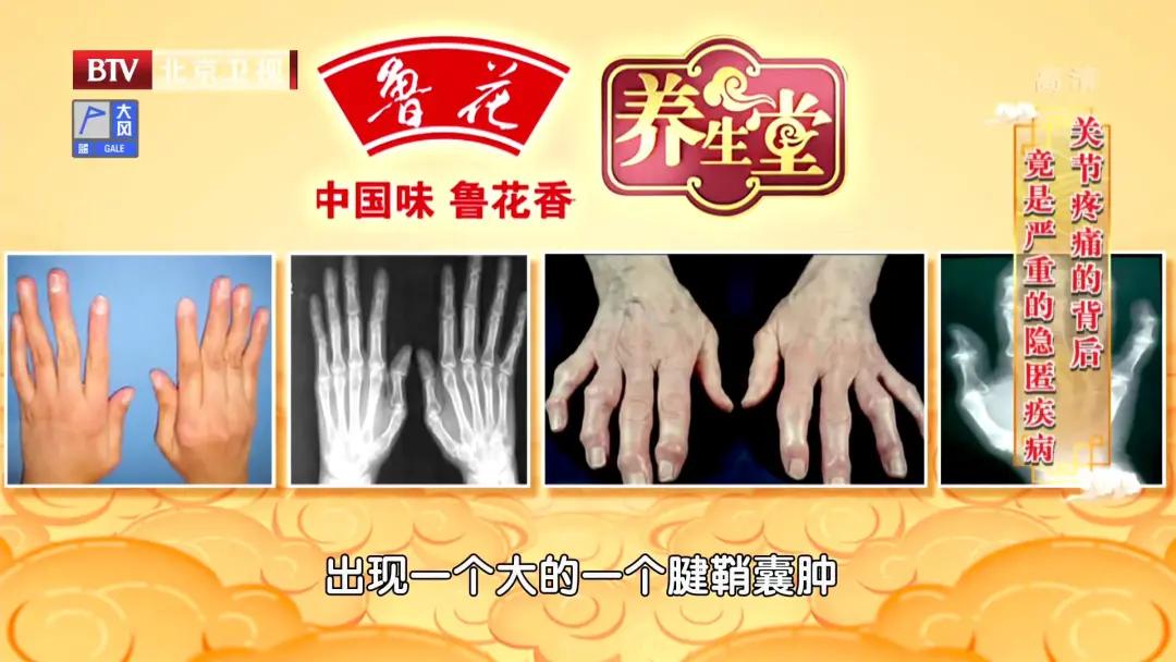 夏季治疗风湿的四大穴位,类风湿病中医穴位按摩