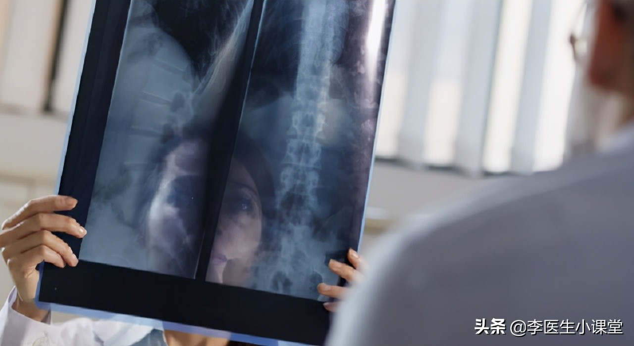 腰间盘突出症，除了药物治疗，康复锻炼是否可行？怎么做才正确？