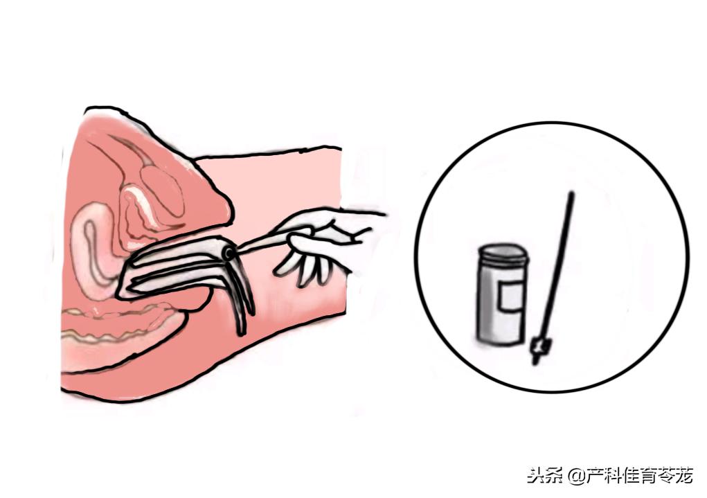 宫颈囊肿7*6mm纳氏囊肿需要治疗吗,宫颈囊肿巧克力囊肿