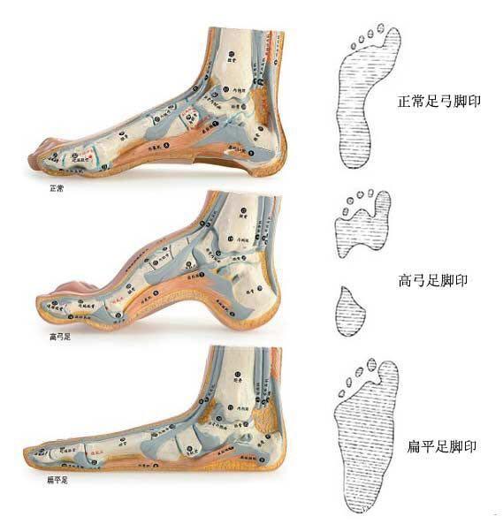 改善扁平足o型腿的训练方法,扁平足导致的膝超伸怎么改善