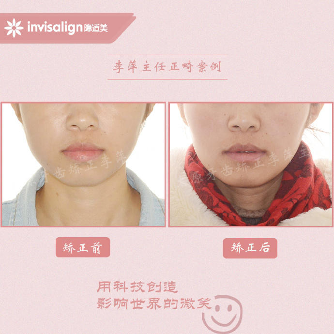 成都牙齿有缝隙怎么矫正,牙齿拥挤矫正前两天不痛正常吗