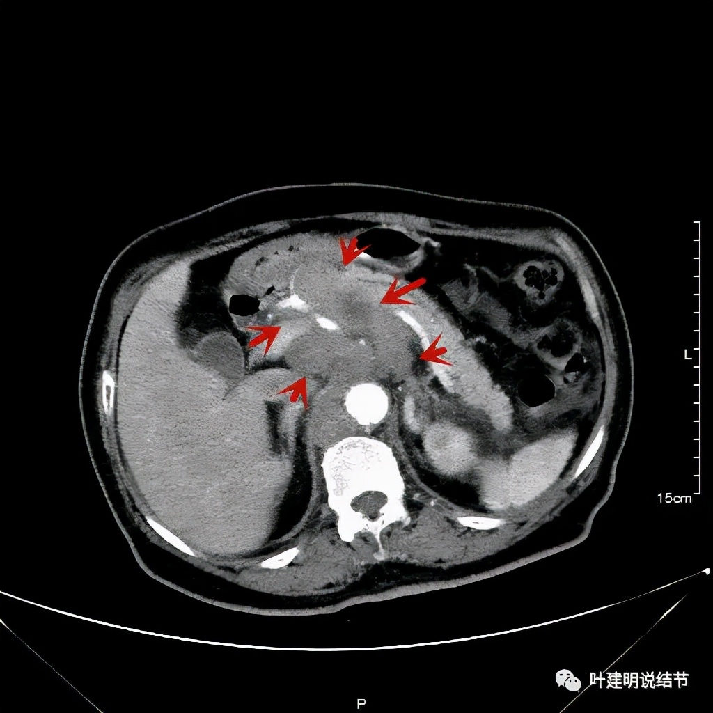 特瑞普利单抗食管癌成功案例,特瑞普利单抗治疗食管癌效果好吗