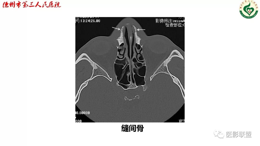 鼻骨骨折影像,鼻骨骨折dr影像表现