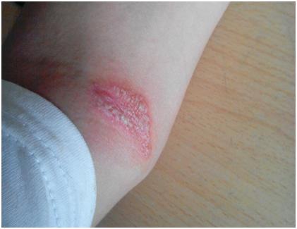 23岁女孩得了银屑病怎么办,学生得银屑病怎么办