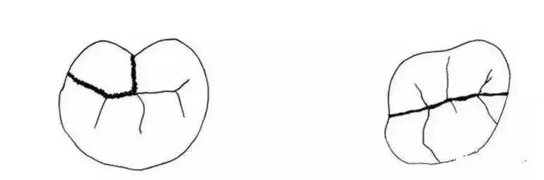 牙齿咬到硬物裂了一小块,牙齿咬到沙子疼痛的原因