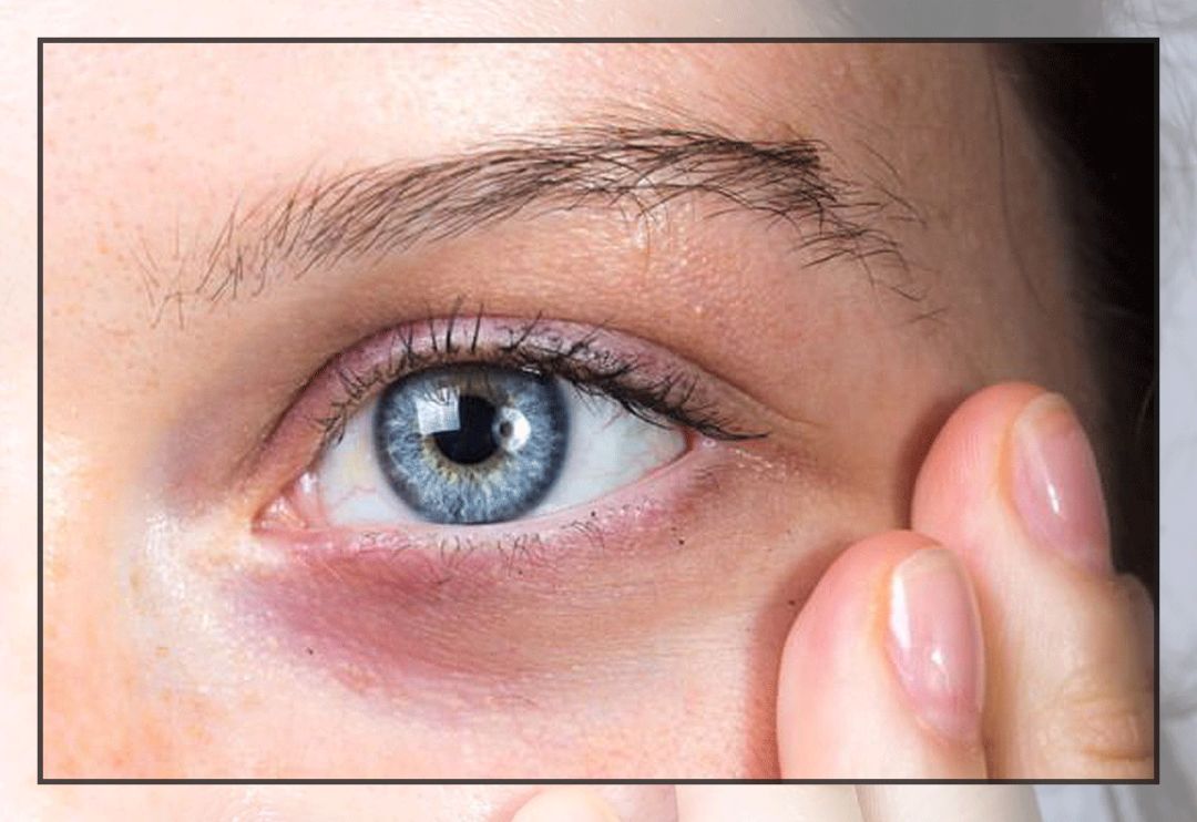 一次就能让黑眼圈消失的办法,一针下去瞬间没了黑眼圈