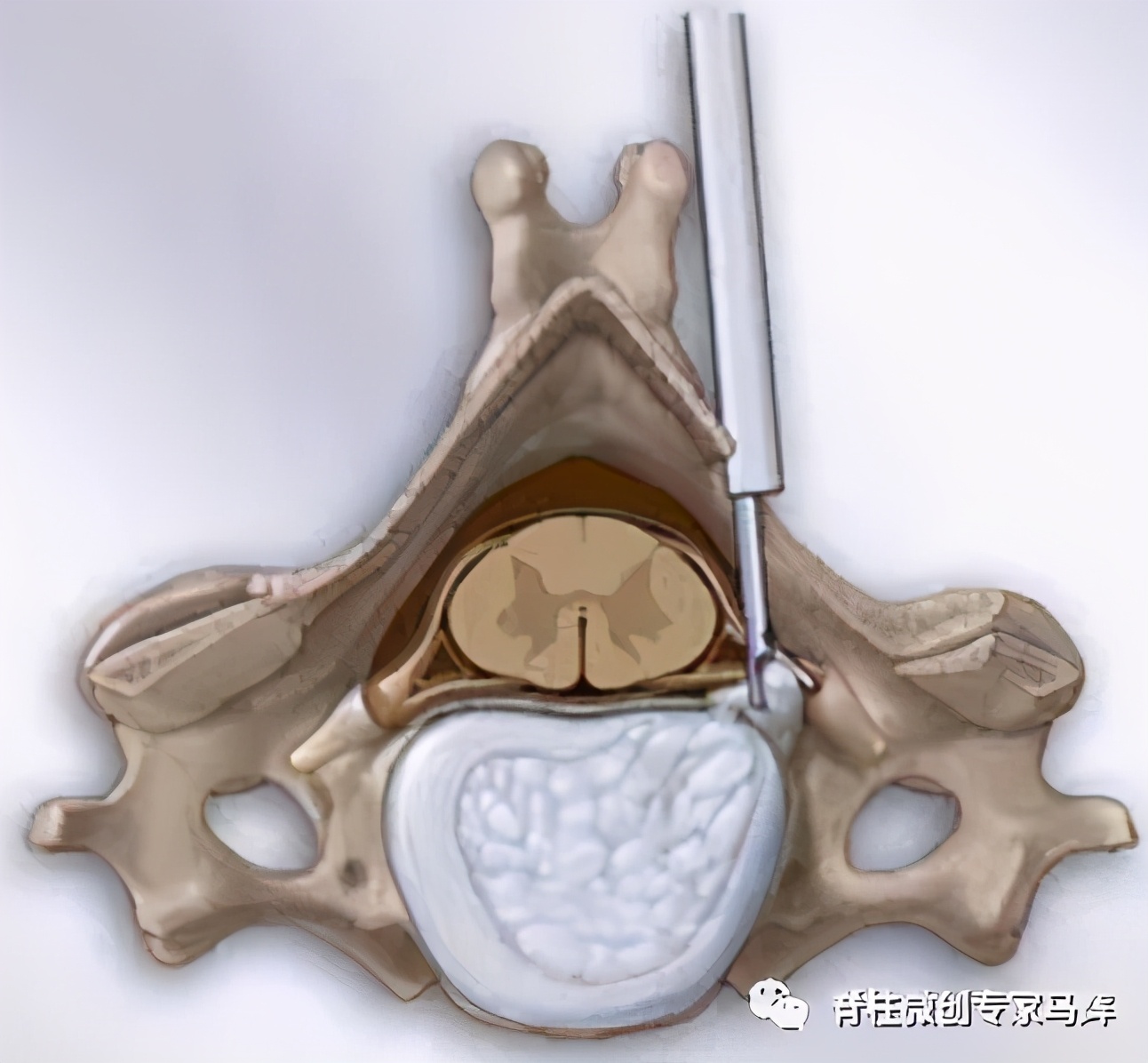 脊椎狭窄压迫神经腿疼怎么治疗,神经根痛上肢麻木怎么康复