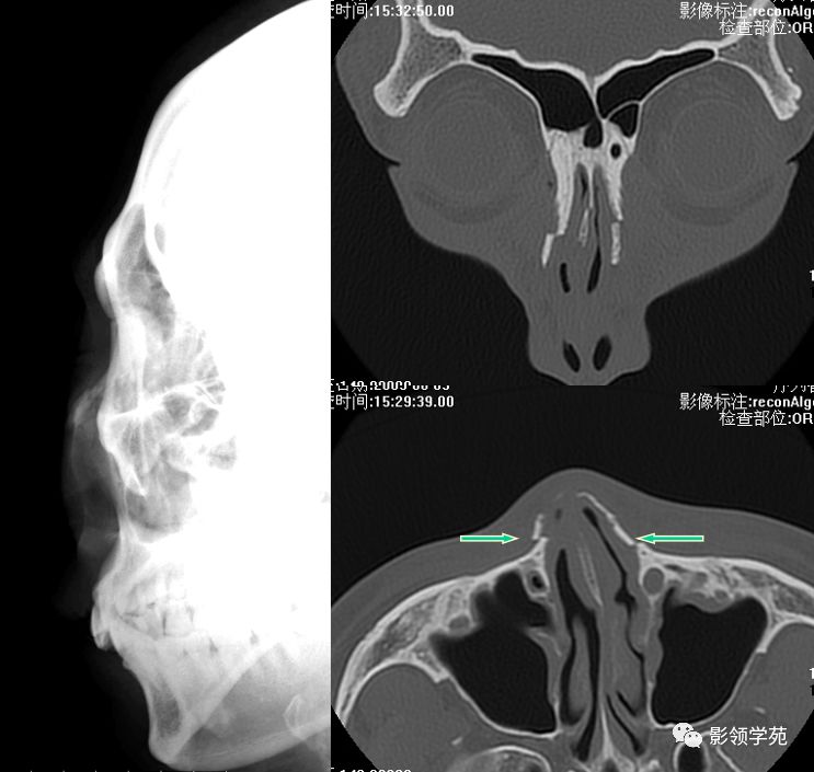 鼻骨影像学解剖,鼻骨解剖及骨折影像学诊断