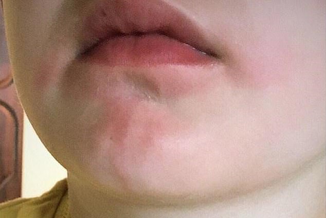 阳光下吃柑橙冰棍或冷饮，医生提醒，可能引起孩子植物阳光皮炎