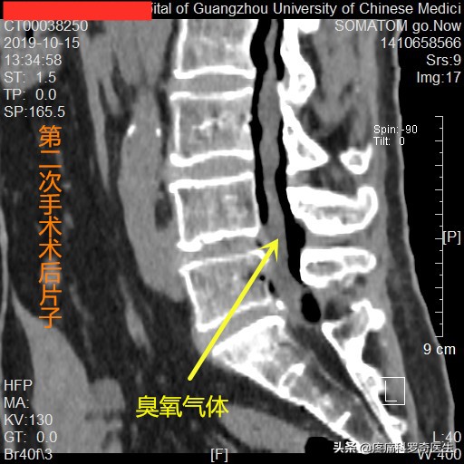 腰椎间盘突出神经根粘连能自愈吗,腰椎微创手术后神经根粘连怎么办