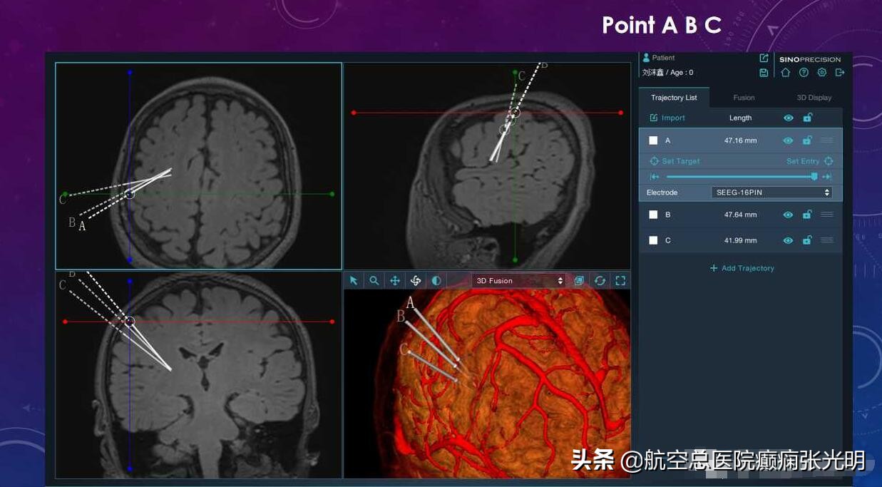 张光明左颞叶癫痫手术成功率,张光明谈治疗癫痫的方法有哪些