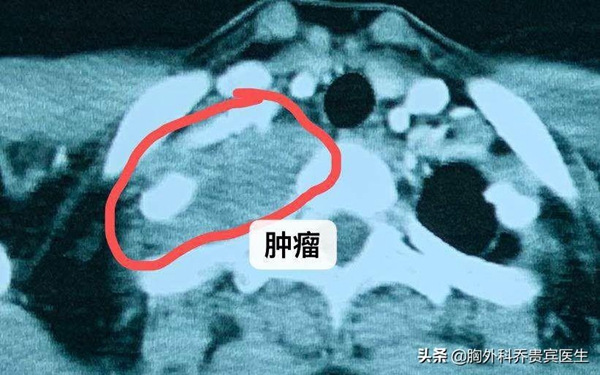 年轻妈妈孕期右手臂疼痛，原来右颈胸长了巨大肿瘤