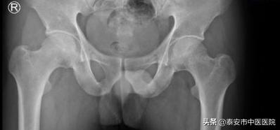 坏死的股骨头还能保得住吗？——*安泰**市中医医院脊柱外科助力患者进行股骨头坏死保髋治疗