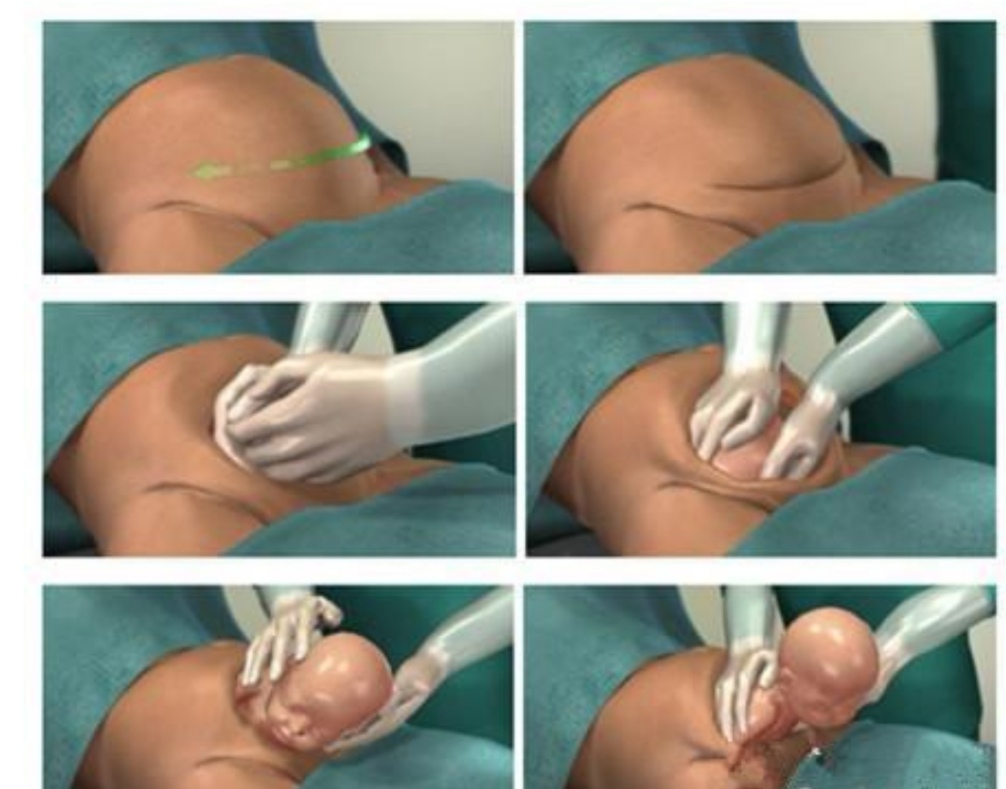 自然分娩是什么的分娩方式,自然分娩什么情况下需要剖腹产