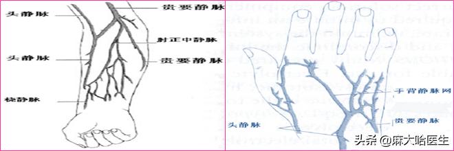 打静脉针,静脉扎针不回血是怎么回事