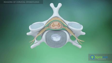 肩膀突然痛手抬起就痛什么原因,肩膀疼痛手臂抬不起多久能好转