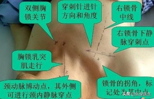 做透析不需要打麻醉吧,透析要留置针吗