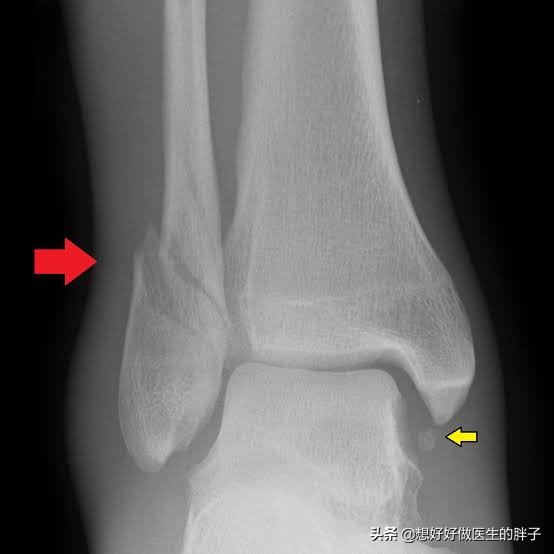 腓骨远端损伤后，如恢复特别慢，有哪些常见原因，又该如何应对呢
