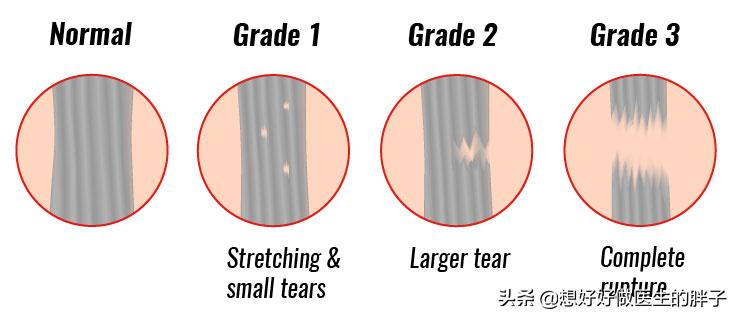 筋损伤怎么恢复最快最有效,筋是如何修复的