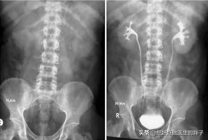 左侧腹部隐痛检查不出原因,肚脐眼左侧腹部隐痛做哪些检查