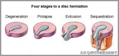 腰间盘突出髓核会掉下来吗,腰间盘突出髓核掉进椎管