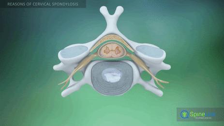 颈椎病一招痊愈是真的吗,颈椎病犯了太可怕了怎么治疗能好