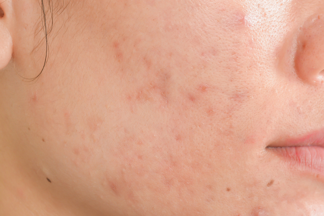 痘印和色斑什么东西最好遮,痘印色斑怎么最有效去除