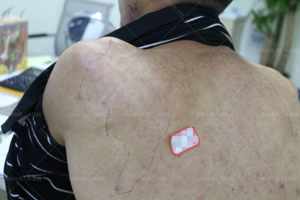 中医疤痕疙瘩怎么能彻底消除,郑州第二中医院治疤痕疙瘩有用吗