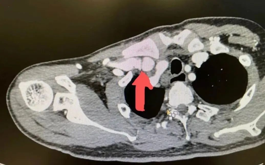 透析患者静脉瓣增生狭窄肾内科血管腔内治疗解决烦恼