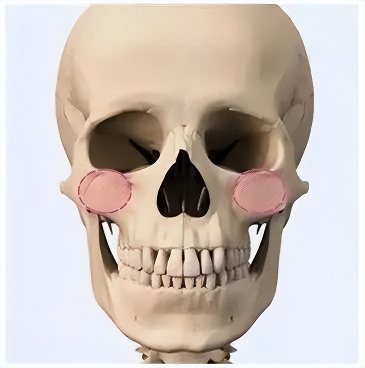 颧骨外扩怎么科学改善,怎么判断是颧骨突出还是颧弓外扩