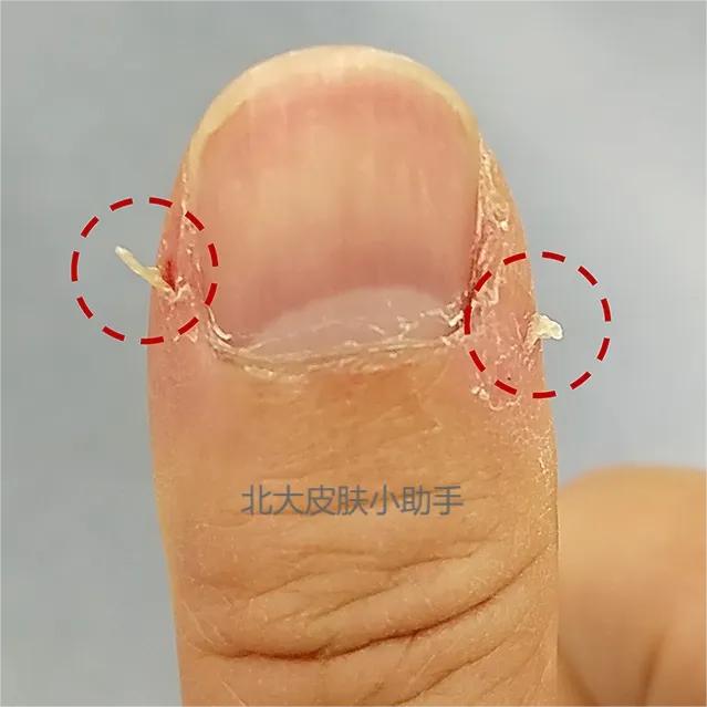 手贱喜欢抠指甲怎么办,撕掉手指甲盖死皮