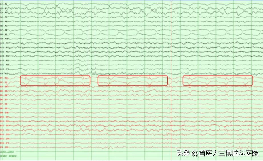 三博脑科医院脊髓外肿瘤手术,三博医院垂体瘤专家