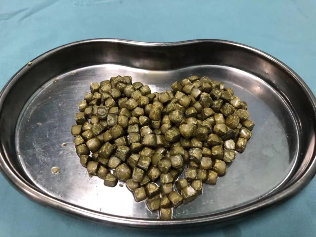 湿热引起的是什么结石,湿热长结石