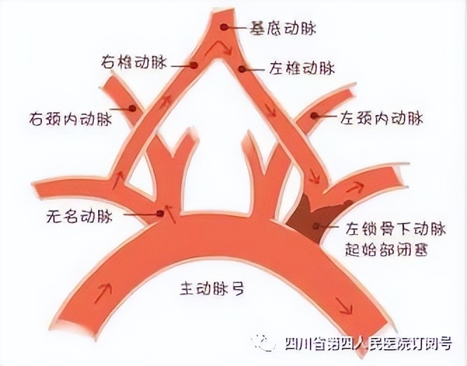 我院首例！左锁骨下动脉支架成形术取得成功，患者已得到改善