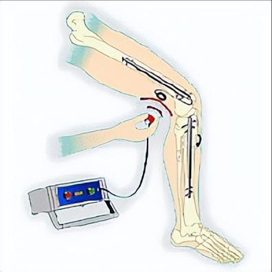德国断骨增高20厘米,德国最新断骨增高术
