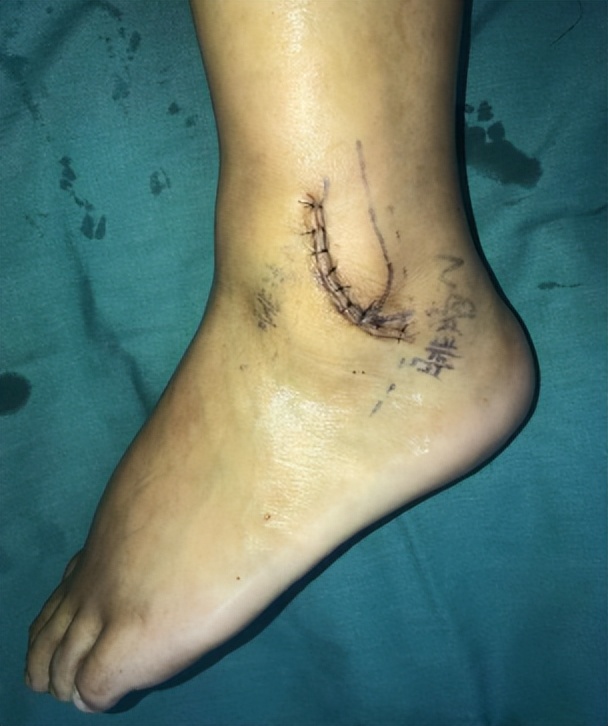 足踝术后一年一直酸疼怎么回事,足踝术后肿痛正常吗