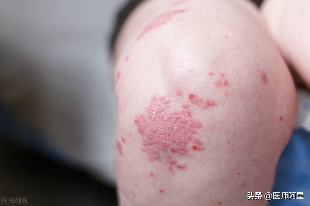 中医治疗湿疹效果好吗,湿疹看中医还是西医好