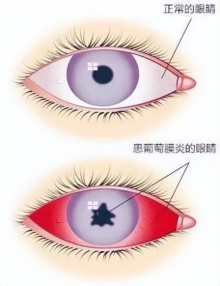 眼干眼涩眼模糊不清吃啥药,眼干眼涩看不清怎么治