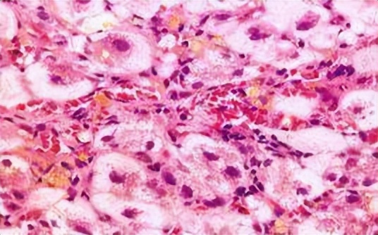 患有乙肝的人，一直不吃药也不治疗，会怎么样呢？