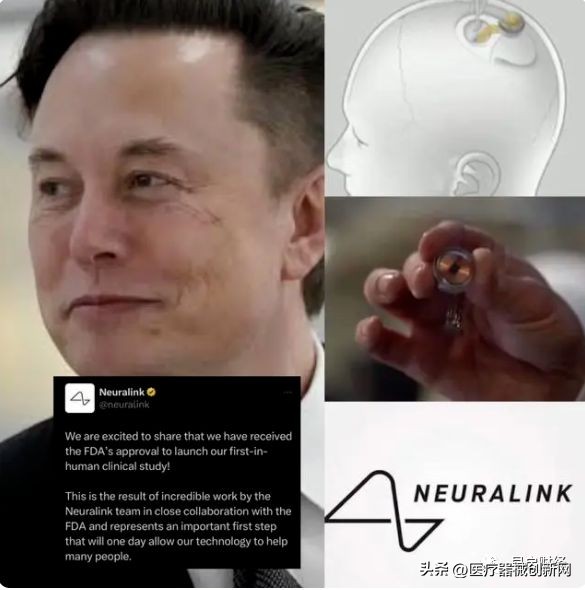 马斯克脑机接口临床试验是真的吗,fda马斯克脑机接口