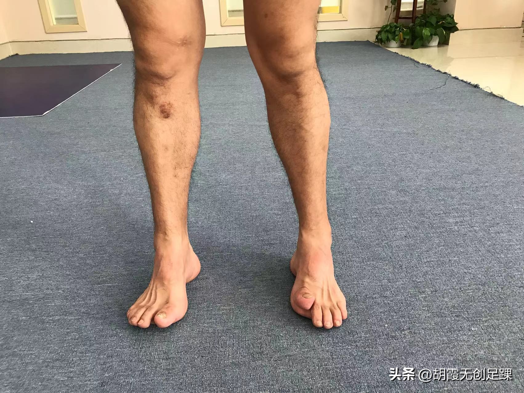 高弓足外翻怎么治疗,高弓足与扁平足哪种易治疗